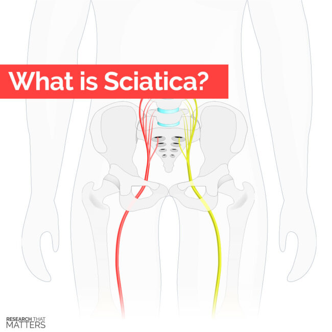 What is Sciatica(c)